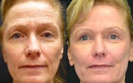 What is laser resurfacing for wrinkles and how does it work?