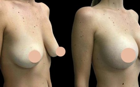 Who Should Consider Breast Augmentation Surgery in Dubai?