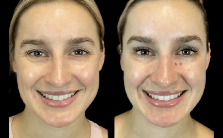 How the Best Doctors in dubai Tailor Botox Treatments by Face Shape