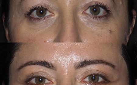 Can Eye Bag Removal Surgery in Dubai Improve Your Vision?