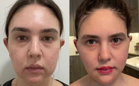 Buccal Fat Removal Surgery in Dubai: What to Expect Before and After