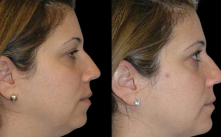 Can Double Chin Removal Surgery in Dubai Help with Sagging Skin?