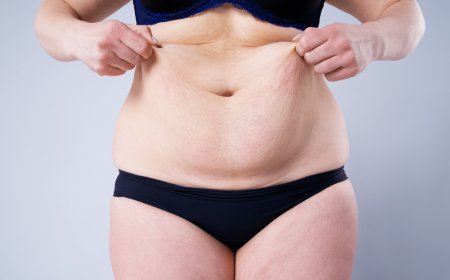 How Tummy Tuck Surgery in Dubai Can Help You Achieve a Slimmer Silhouette