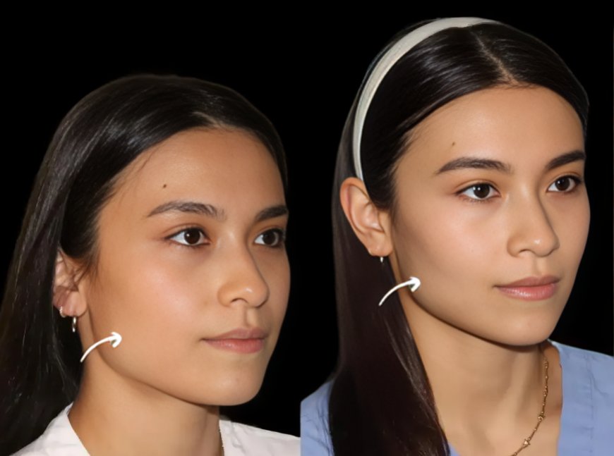 Sculptra Fillers Treatments in Dubai: Patient Experience Journey