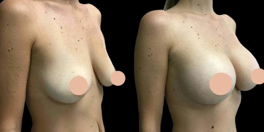 Who Should Consider Breast Augmentation Surgery in Dubai?