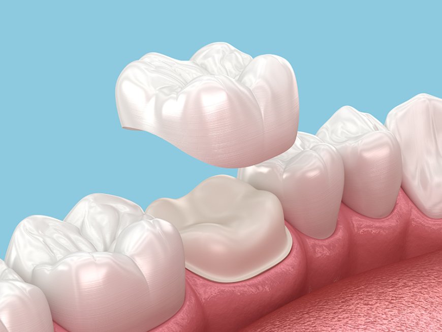 Dental Crowns Dubai: Restore Strength and Beauty to Damaged Teeth