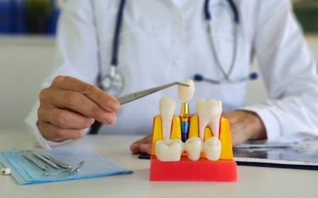 😁 Regain Confidence in Your Smile with Dental Crowns