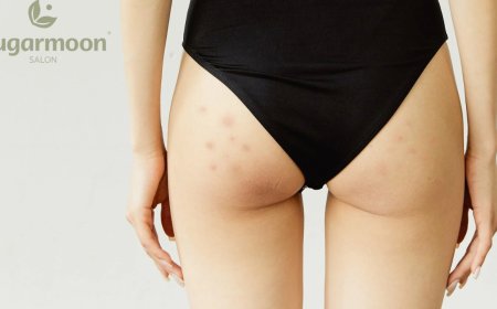 Hyperpigmentation on the Buttocks: Causes, Treatments, and Prevention for Smoother Skin