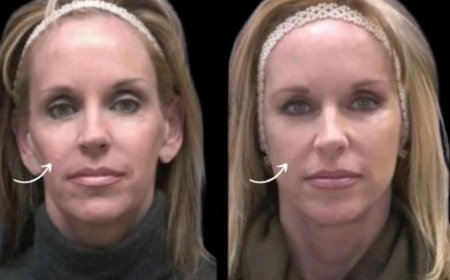 Best Plastic Surgeon in Dubai on avoiding lumps after Sculptra Fillers